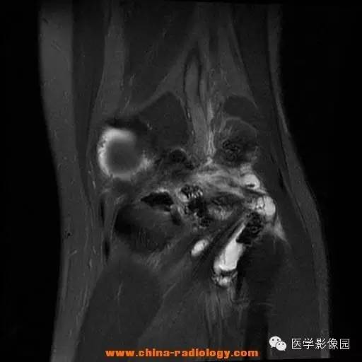 【病例】色素沉着绒毛结节性滑膜炎1例MR影像表现 【病例】色素沉着绒毛结节性滑膜炎1例MR影像表现