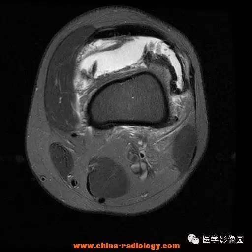 【病例】色素沉着绒毛结节性滑膜炎1例MR影像表现 【病例】色素沉着绒毛结节性滑膜炎1例MR影像表现