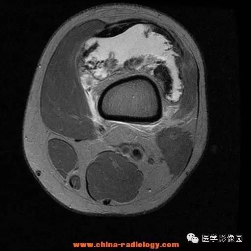 【病例】色素沉着绒毛结节性滑膜炎1例MR影像表现 【病例】色素沉着绒毛结节性滑膜炎1例MR影像表现