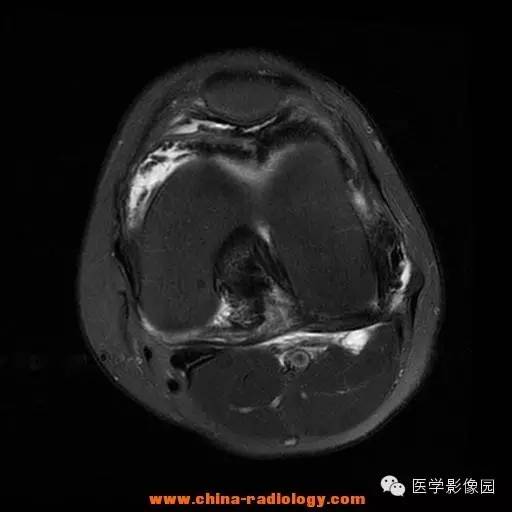 【病例】色素沉着绒毛结节性滑膜炎1例MR影像表现 【病例】色素沉着绒毛结节性滑膜炎1例MR影像表现