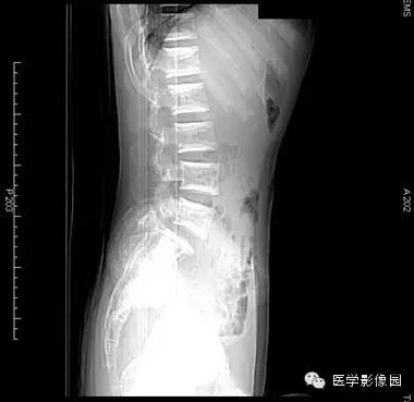 【病例】石骨症1例X线CT影像表现