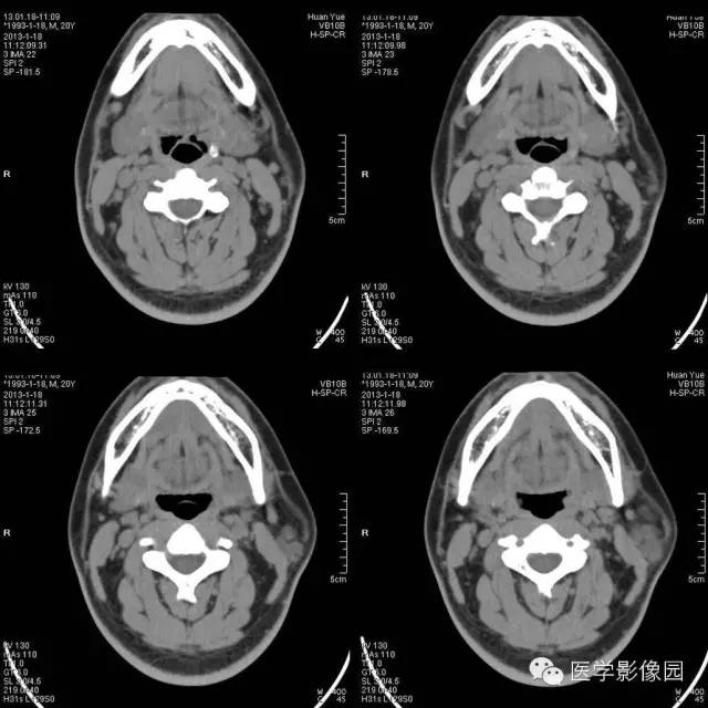 【病例】腮腺血管瘤1例CT影像表现