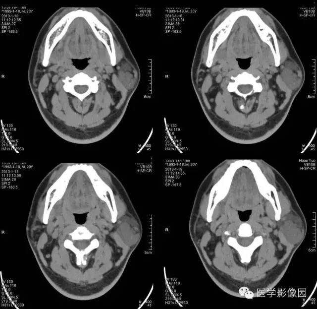 【病例】腮腺血管瘤1例CT影像表现