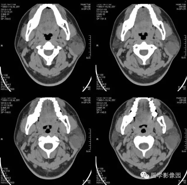 【病例】腮腺血管瘤1例CT影像表现