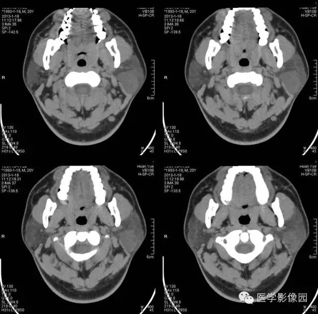 【病例】腮腺血管瘤1例CT影像表现