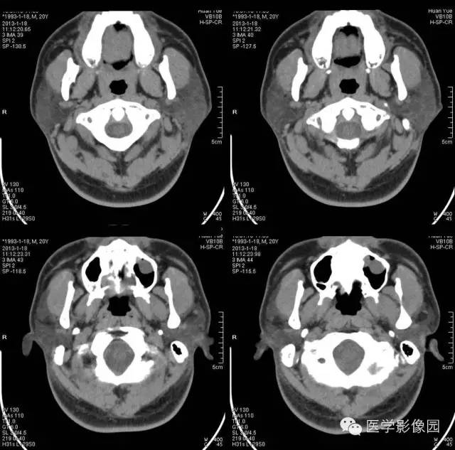【病例】腮腺血管瘤1例CT影像表现