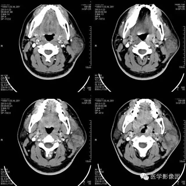 【病例】腮腺血管瘤1例CT影像表现