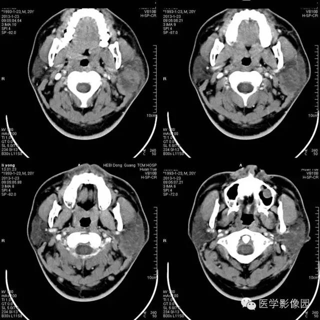 【病例】腮腺血管瘤1例CT影像表现