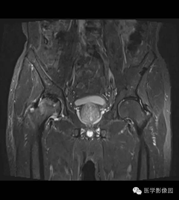 【病例】股骨头缺血坏死1例MR影像表现 【病例】股骨头缺血坏死1例MR影像表现