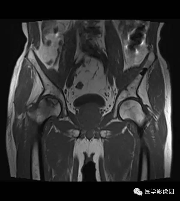 【病例】股骨头缺血坏死1例MR影像表现 【病例】股骨头缺血坏死1例MR影像表现
