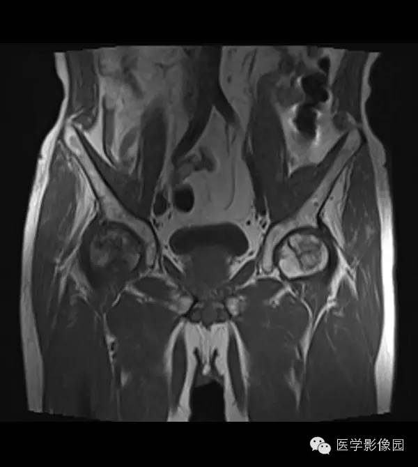 【病例】股骨头缺血坏死1例MR影像表现 【病例】股骨头缺血坏死1例MR影像表现