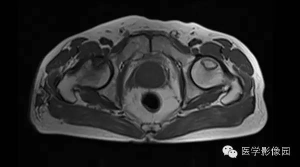 【病例】股骨头缺血坏死1例MR影像表现 【病例】股骨头缺血坏死1例MR影像表现