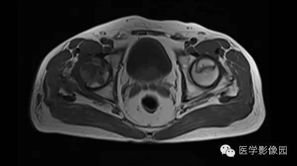 【病例】股骨头缺血坏死1例MR影像表现 【病例】股骨头缺血坏死1例MR影像表现