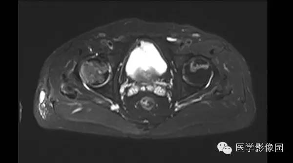 【病例】股骨头缺血坏死1例MR影像表现 【病例】股骨头缺血坏死1例MR影像表现