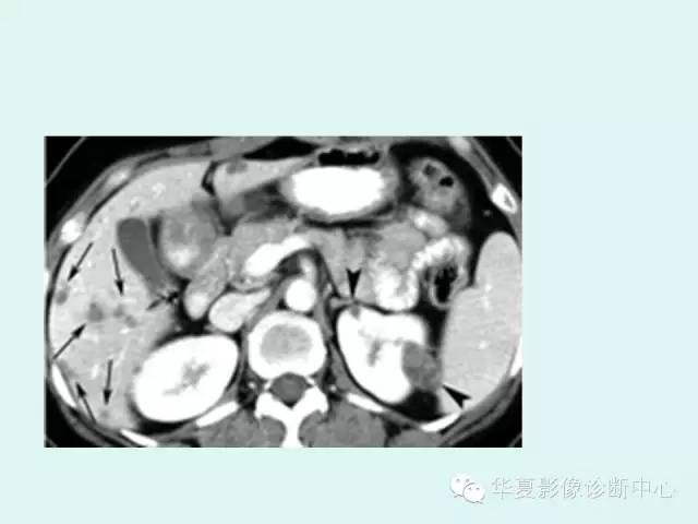 【PPT】肾结核CT诊断