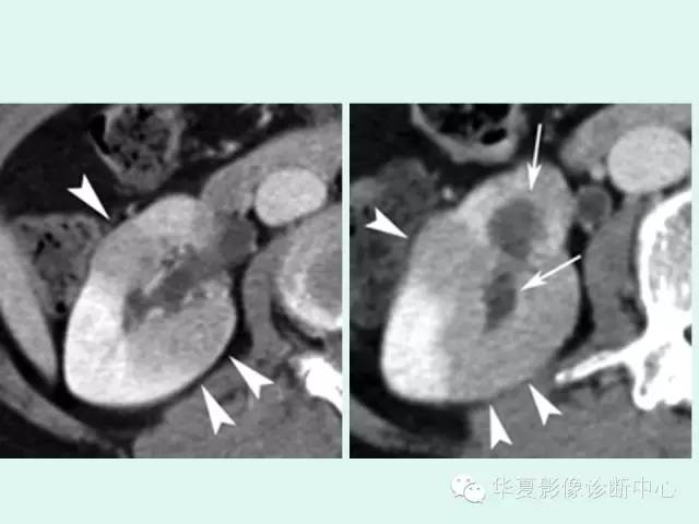 【PPT】肾结核CT诊断