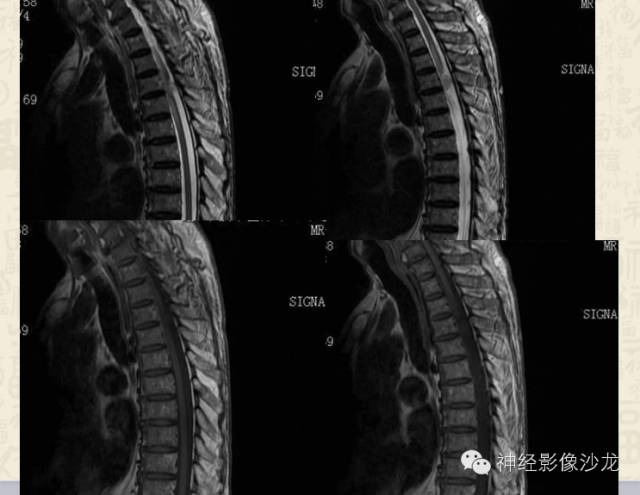 【病例】脊髓血管母细胞瘤1例MR影像表现