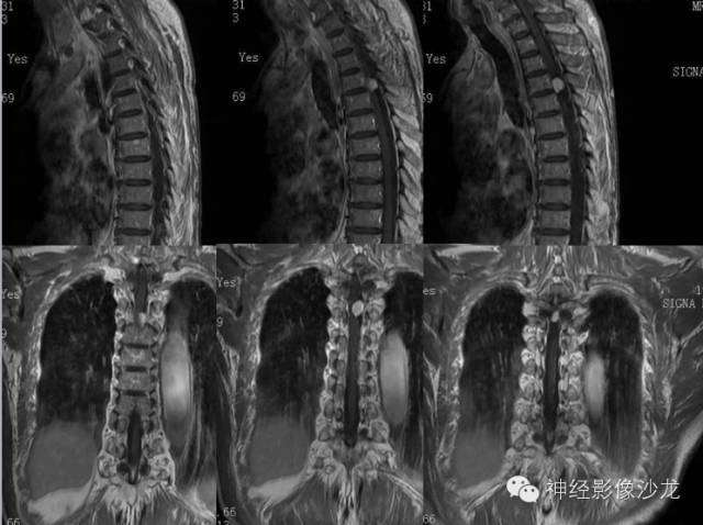 【病例】脊髓血管母细胞瘤1例MR影像表现