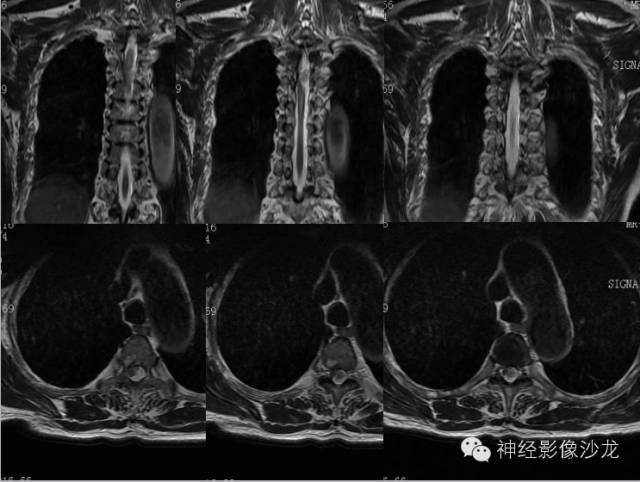 【病例】脊髓血管母细胞瘤1例MR影像表现