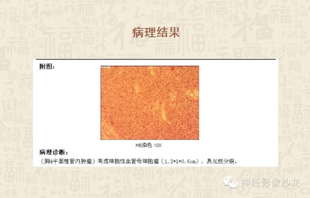 【病例】脊髓血管母细胞瘤1例MR影像表现