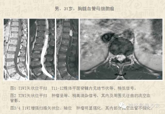 【病例】脊髓血管母细胞瘤1例MR影像表现