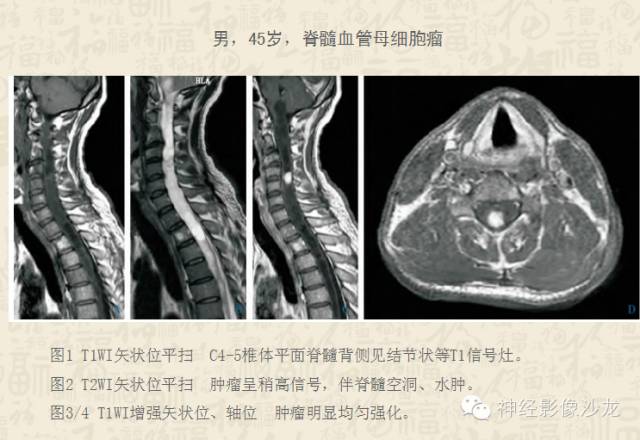 【病例】脊髓血管母细胞瘤1例MR影像表现