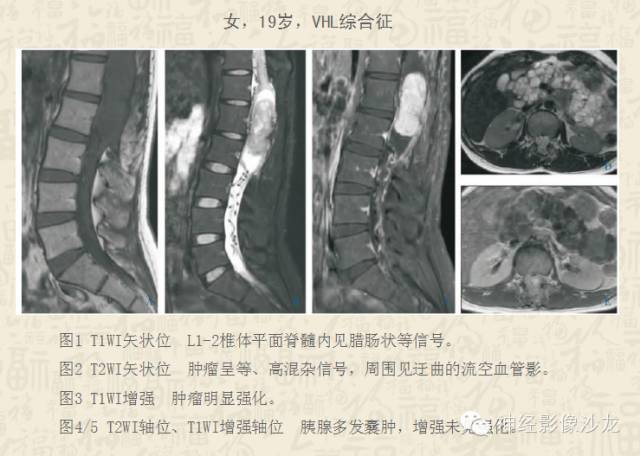 【病例】脊髓血管母细胞瘤1例MR影像表现