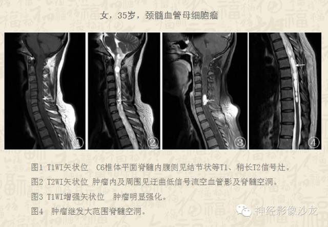 【病例】脊髓血管母细胞瘤1例MR影像表现