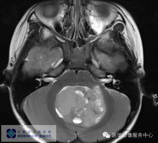 【病例】四脑室室管膜瘤1例MR影像表现