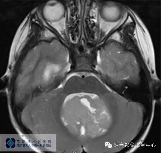 【病例】四脑室室管膜瘤1例MR影像表现 【病例】四脑室室管膜瘤1例MR影像表现
