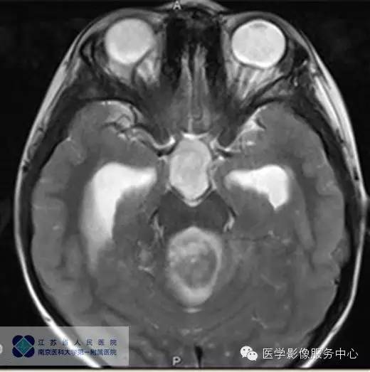 【病例】四脑室室管膜瘤1例MR影像表现 【病例】四脑室室管膜瘤1例MR影像表现