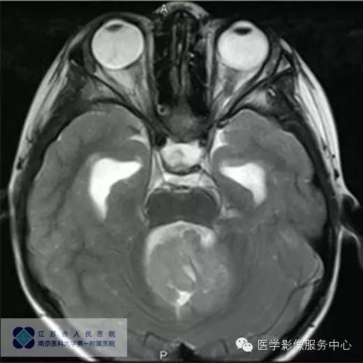 【病例】斜坡脊索瘤1例CT及MR影像表现 【病例】斜坡脊索瘤1例CT及MR影像表现