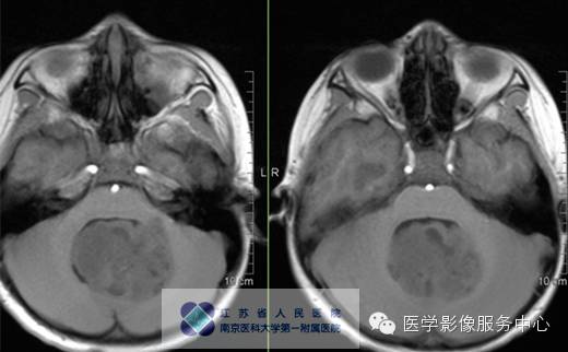 【病例】斜坡脊索瘤1例CT及MR影像表现 【病例】斜坡脊索瘤1例CT及MR影像表现