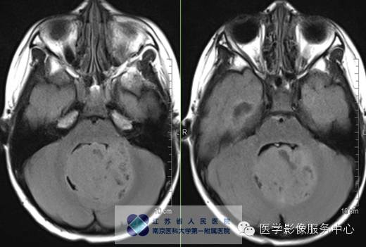 【病例】斜坡脊索瘤1例CT及MR影像表现 【病例】斜坡脊索瘤1例CT及MR影像表现