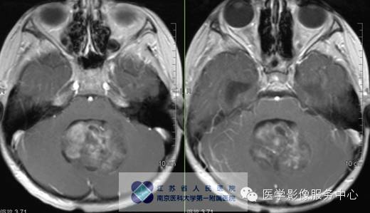 【病例】斜坡脊索瘤1例CT及MR影像表现 【病例】斜坡脊索瘤1例CT及MR影像表现