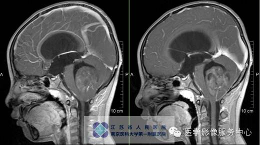 【病例】斜坡脊索瘤1例CT及MR影像表现 【病例】斜坡脊索瘤1例CT及MR影像表现