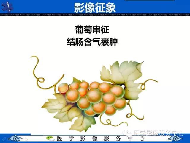 影像征象——葡萄串征