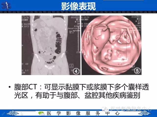 影像征象——葡萄串征