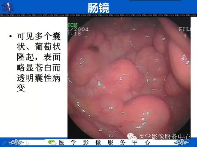 影像征象——葡萄串征