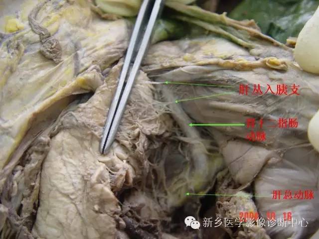 【PPT】胰腺癌侵犯周围神经丛的CT和MRI表现