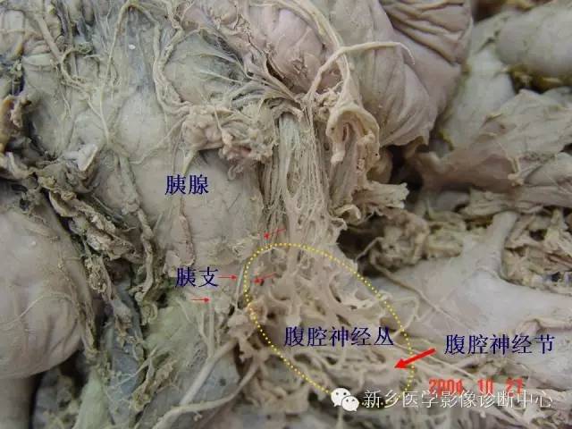 【PPT】胰腺癌侵犯周围神经丛的CT和MRI表现
