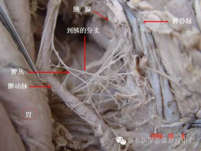 【PPT】胰腺癌侵犯周围神经丛的CT和MRI表现