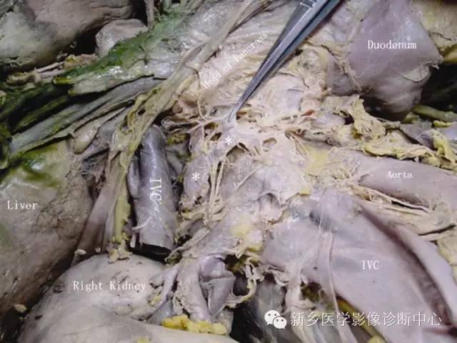 【PPT】胰腺癌侵犯周围神经丛的CT和MRI表现