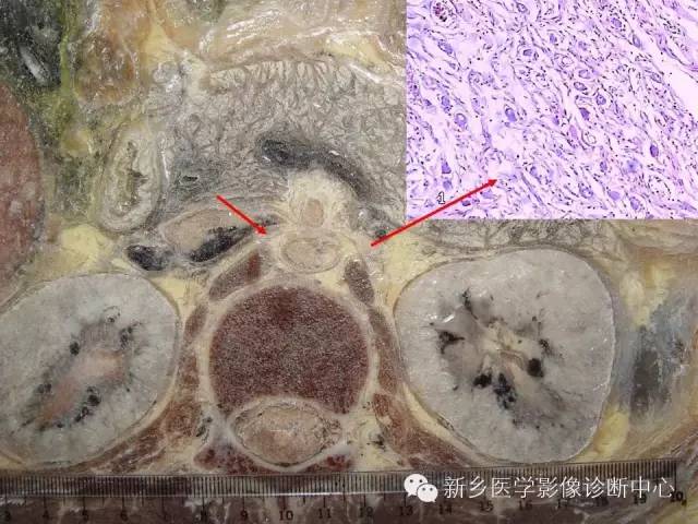 【PPT】胰腺癌侵犯周围神经丛的CT和MRI表现