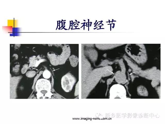 【PPT】胰腺癌侵犯周围神经丛的CT和MRI表现