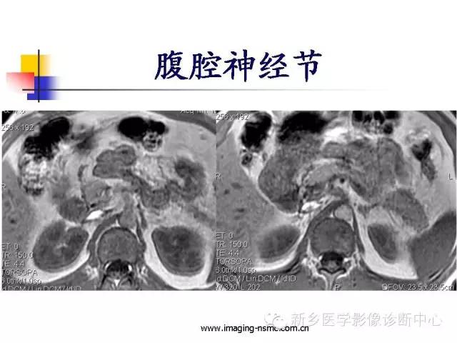 【PPT】胰腺癌侵犯周围神经丛的CT和MRI表现