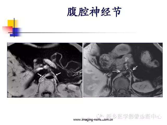 【PPT】胰腺癌侵犯周围神经丛的CT和MRI表现