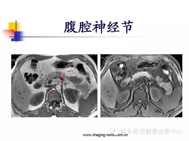 【PPT】胰腺癌侵犯周围神经丛的CT和MRI表现