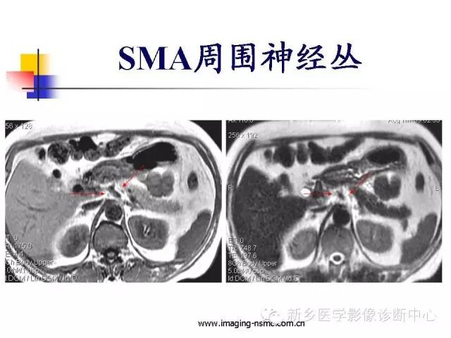 【PPT】胰腺癌侵犯周围神经丛的CT和MRI表现