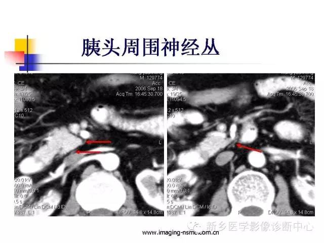 【PPT】胰腺癌侵犯周围神经丛的CT和MRI表现